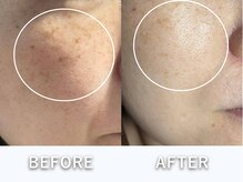 ヒトハダ(hitohada)/40代女性　《シミケア4回》