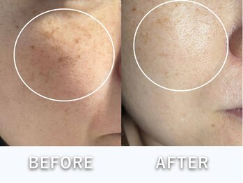 ヒトハダ(hitohada)/40代女性 《シミケア4回》