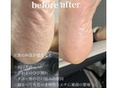 韓国式足裏角質ケア