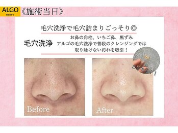 アルゴ 南茨木駅前店(ALGO)/【毛穴洗浄で汚れゴッソリ】