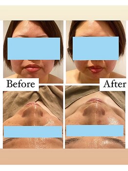 ポノ(Pono)の写真/フェイスラインまでくっきり！！むくみ・たるみを整えて、横顔まで美しい小顔へ♪
