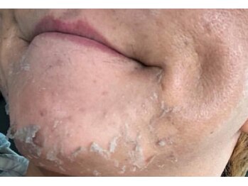 ピアリーノ(Pialino)/ハーブピーリング剥離中