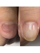 ネイル アンチュ(Nail Anchu)/自爪育成／深爪