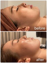 スピード美人 本八幡店/ハーブピーリングで陶器肌