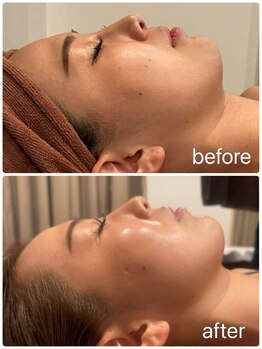 スピード美人 本八幡店/ハーブピーリングで陶器肌