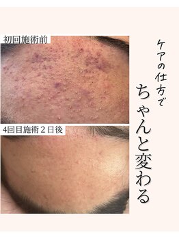 アネラ(Anela)/正しいスキンケアを！