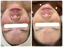 アンド ユー(and.yu)/シミケア・美肌コース2回