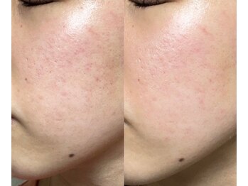 ユウビ ビューティー サロン(Yuubi)/【peel stage】ハーブピーリング