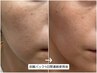 【お肌リセットコース】短期間で肌質改善したい方におすすめ★