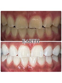 アース(EARTH)/【ビフォーアフター】美白