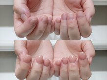 ミンスネイル(Mins Nail)/深爪矯正before&after