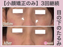 アンリエッタ(Unlieta)/【目の下の変化】