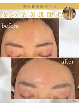 カリス(charis)/金の糸美肌脱毛