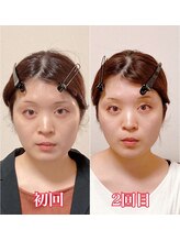 小顔22 ボルティ 赤坂支店(Bolty)/20代：小顔シンメトリー（2回）