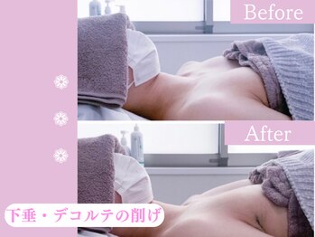 キアナ 横浜店(Kiana)/下垂にお悩みの方Before After