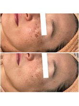 リッツ 大宮店/【Before/After】しみ改善