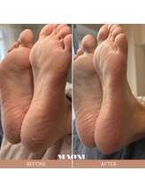 マオヌー(MAONU)/韓国式足裏角質ケア　症例写真