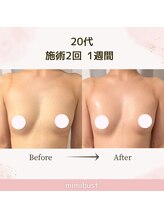 ミミバスト(mimibust)/バストアップBeforeAfter