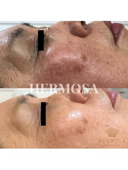 ダリア(Dahlia)/肌育成★ハーブトリートメント