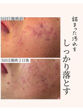 アネラ(Anela)/詰まりケア☆