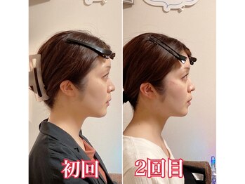 小顔22 ボルティ 赤坂支店(Bolty)/20代：小顔シンメトリー（2回）