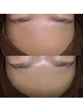 ゴールデンエイジ 吉祥寺(GOLDEN AGE)/ワックス脱毛:施術