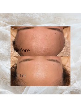 ディアー(Dear)/REVI 陶肌トリートメント