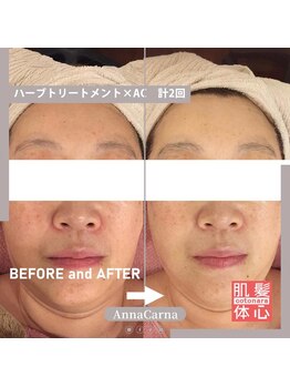 アンナカルナ(AnnaCarna)/短時間で変化する肌にびっくり