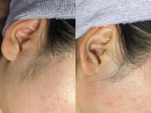 ムーン 横浜(MOON)/【もみあげ】