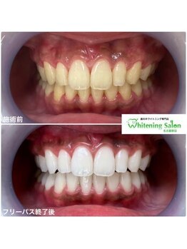 ホワイトニングサロン 名古屋駅店/【ホワイトニング施術例】