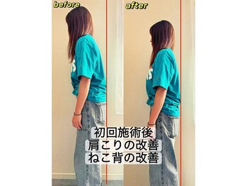 アンティオール 札幌店/20代女性　肩こり/頚部痛/ねこ背