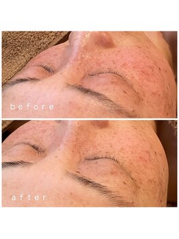 メナードフェイシャルサロン 岐阜茜部/ダブルビタQパック