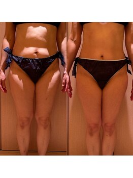 凪 横浜/痩身エステ１回での結果