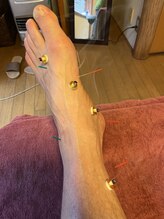 ライズ/Acupuncture to the feet