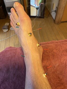 ライズ/Acupuncture to the feet