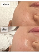 エムベル(M.belle)/リフトアップマッサージ施術前後