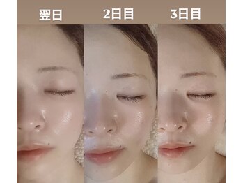 ディサイドロー(DECIDE L.A.W)/初めてのSpecialエステ後！