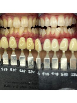 トウキョースワーズ 渋谷店(TOKYO SWRS)/#ホワイトニング #渋谷 #池袋