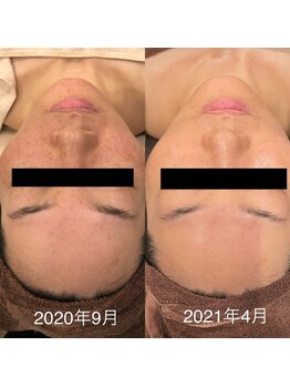 リラ(Rira)/《陶器肌・毛穴レス》施術結果