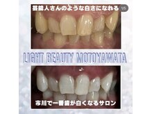 ライトビューティー 本八幡店(LIGHT BEAUTY)/犬歯が濃かったお客様♪