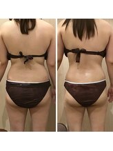 カンフリエ 吉野ヶ里店(Camphrier)/【痩身】ビフォーアフターご紹介