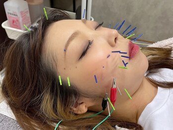 ハリーズエヌ(harry's N)の写真/《国家資格保持者☆美容鍼3000円~》しわやたるみを改善し、若々しい印象へ♪全身のトータルケアもあり！