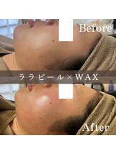 エピナ 横浜店(Epina)/ララピール＋フェイシャルWAX☆
