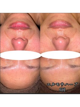 カルム エ コンポーゼ(Calme et Compose')/エルモサハーブ/6回