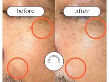 ユヌランコント 岐阜店(Une rencontre)/ハーブピーリング