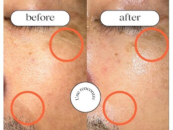 ユヌランコント 岐阜店(Une rencontre)/ハーブピーリング