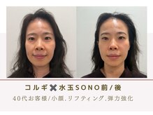 ルナビューティー 赤坂(LUNA beauty)/水玉SONOコルギケア１０回前/後