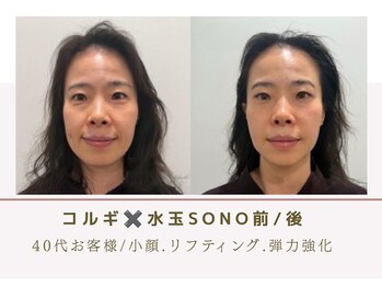 ルナビューティー 赤坂(LUNA beauty)/水玉SONOコルギケア１０回前/後