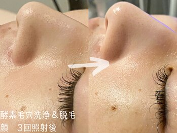 ルーナジェーナ(Luna llena)/顔脱毛で、毛穴・くすみケアも。