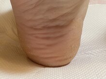 ビサンテ サロン/中々良くならない踵のガサガサに